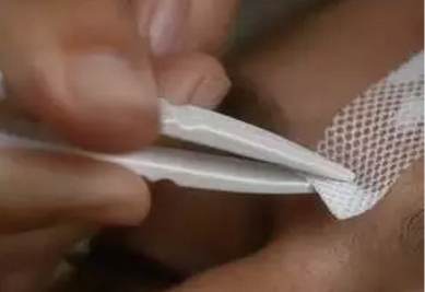 3D打印技術(shù)在植入式醫(yī)療器械中的應(yīng)用