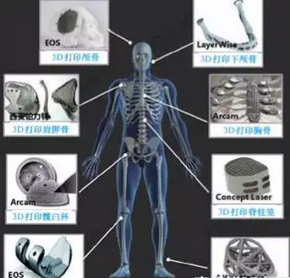 3D打印技術(shù)在植入式醫(yī)療器械中的應(yīng)用