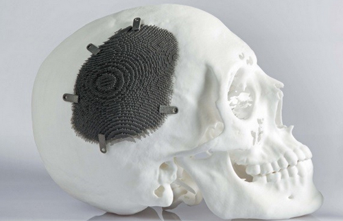 3D打印技術(shù)在植入式醫(yī)療器械中的應(yīng)用