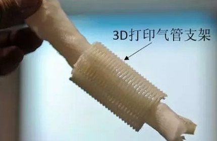 3D打印技術在植入式醫(yī)療器械中的應用